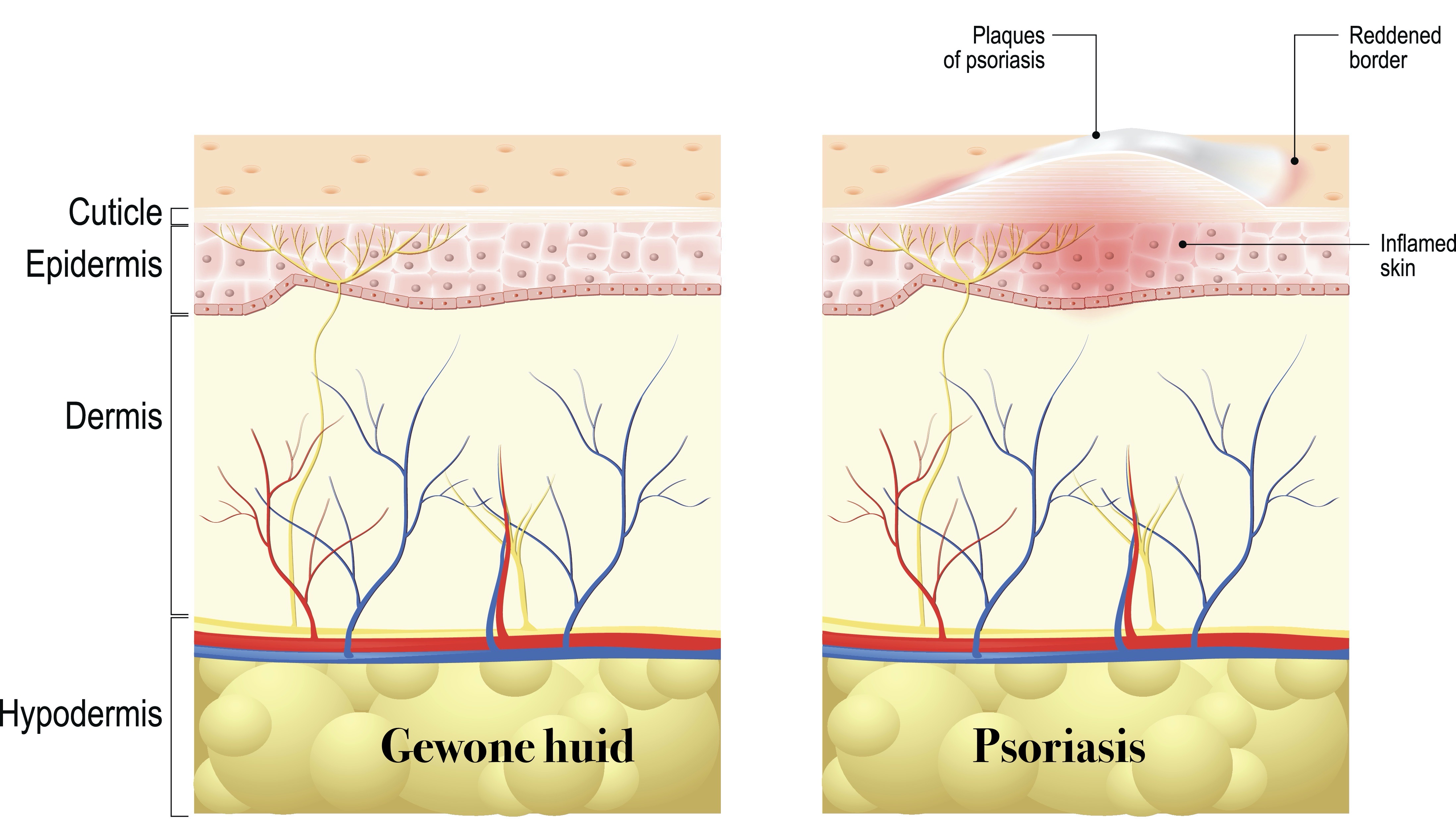 29 oktober: dag van de PSORIASIS
