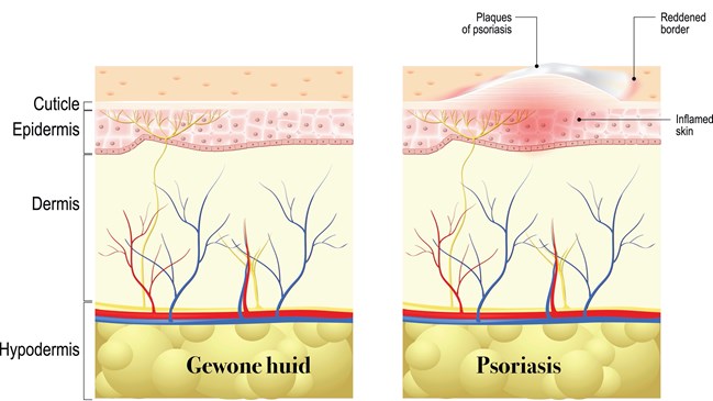 Psoriasis 29-10