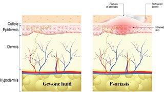 Psoriasis 29-10